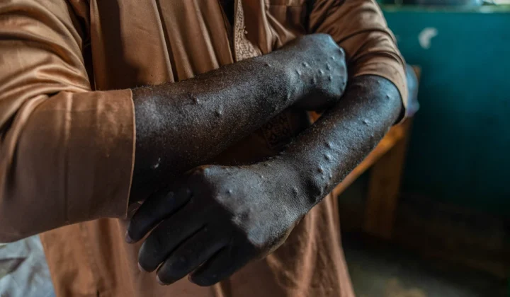Dutch Virologist Charged in US for Smuggling Mpox Samples