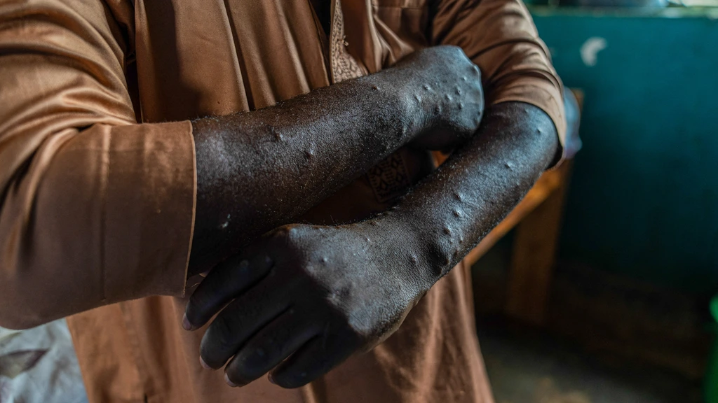 Dutch Virologist Charged in US for Smuggling Mpox Samples